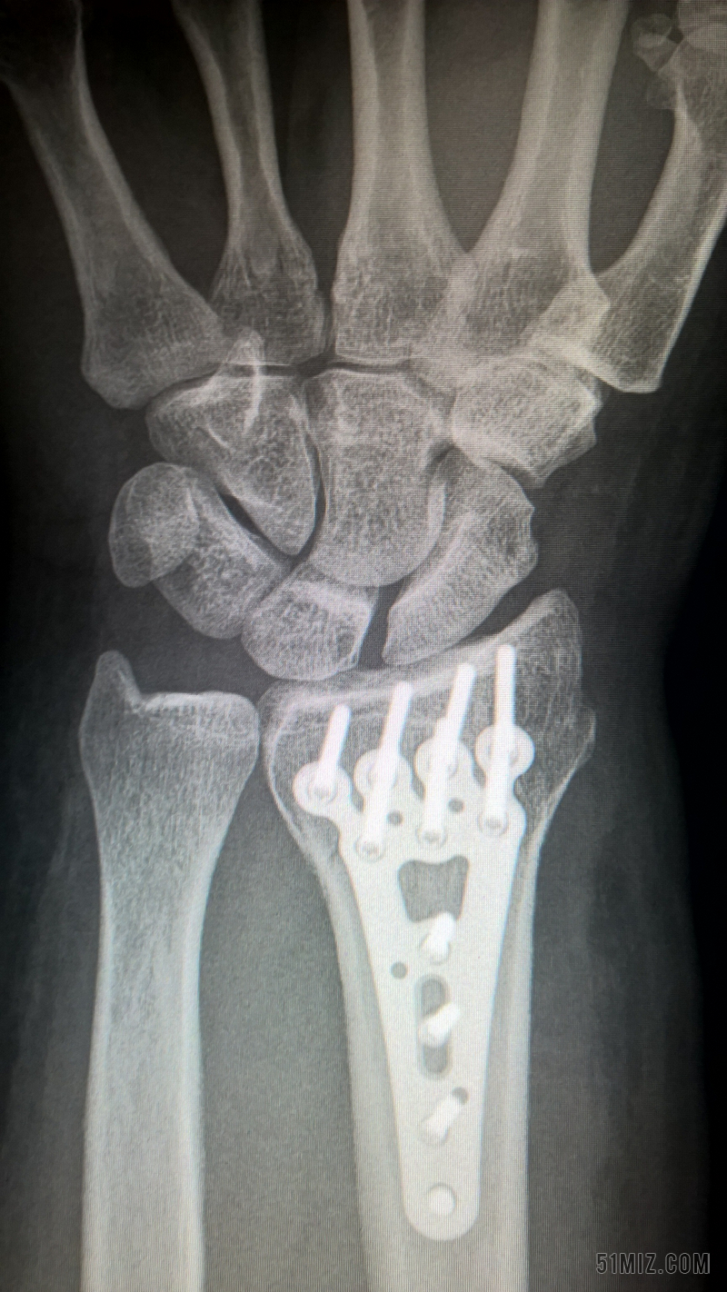 尺骨骨折手术钢板图片图片
